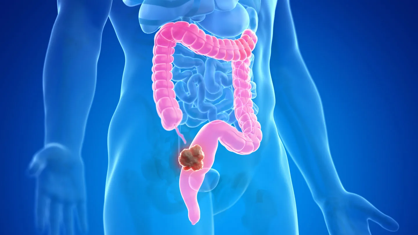 Stomach Cancer Image